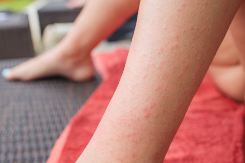Understanding Dermatitis Herpetiformis Better