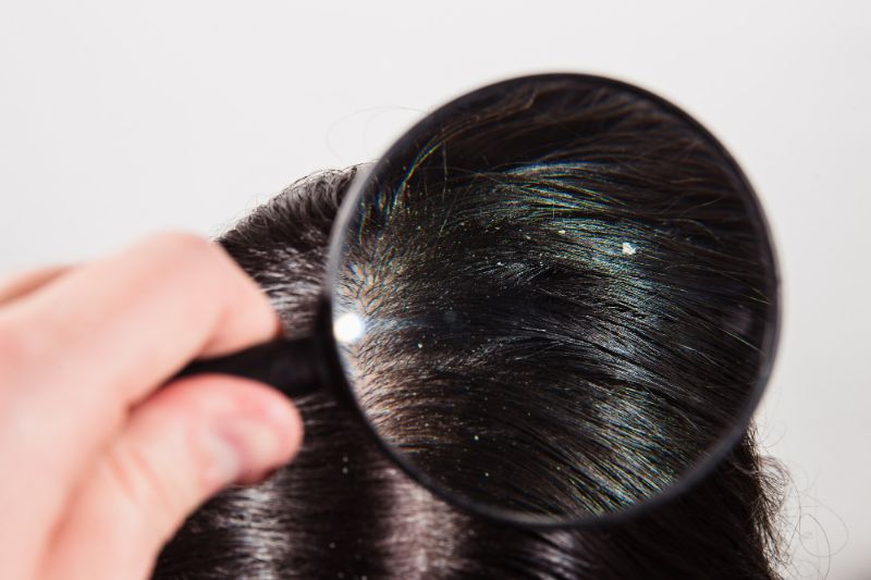 dandruff in summer