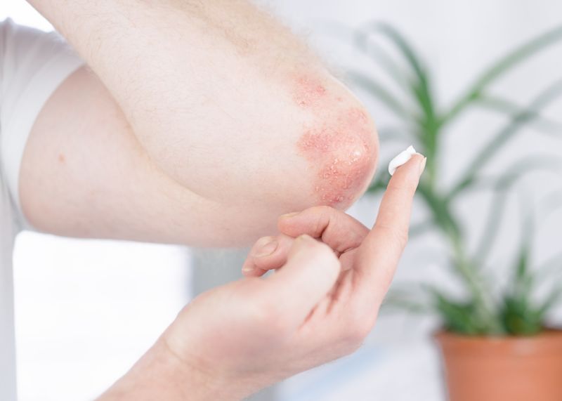 summer eczema treatment
