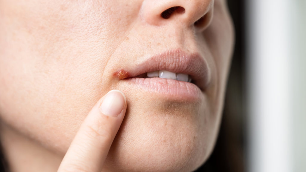 cold sore