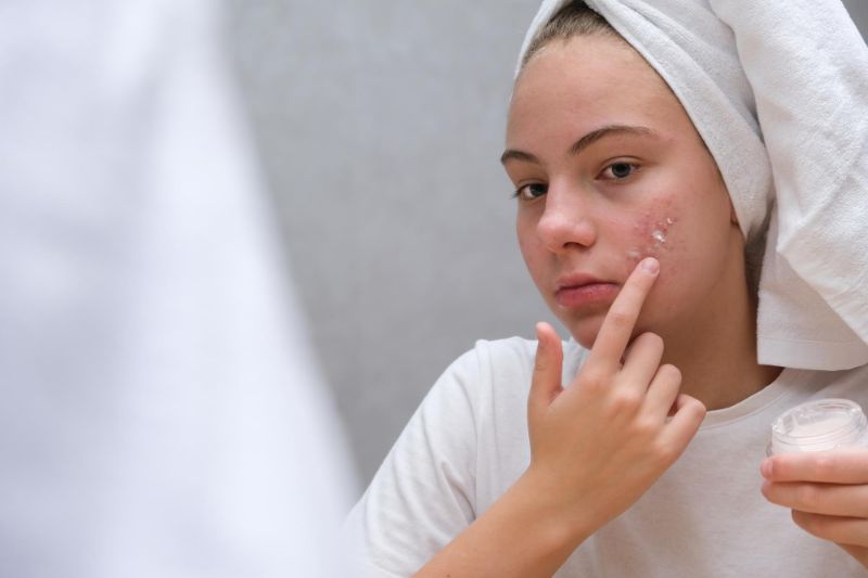 Nodular Acne Treatment: Comprehensive Guide - RemoteDerm