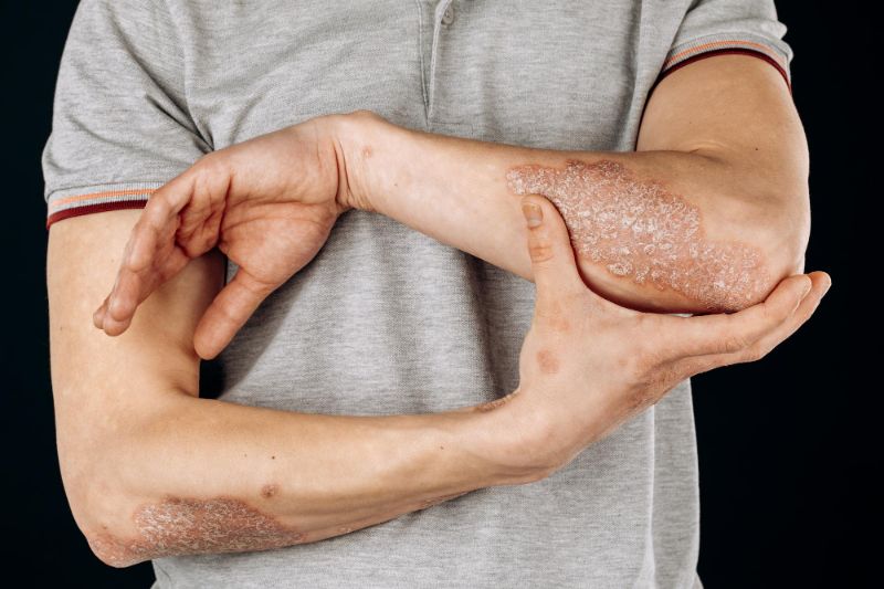 Psoriasis photo