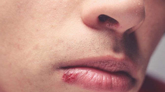 Cold Sore Causes, Symptoms, Treatment -RemoteDerm