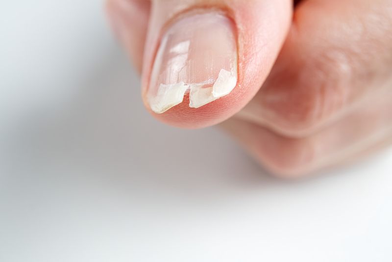 White Spots on Nails: Causes and Treatment Options