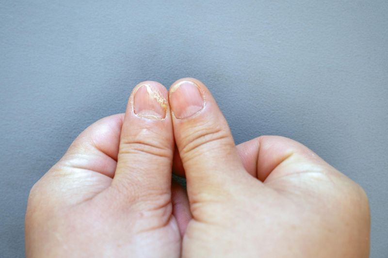 7 Nail Signs of Health Problems