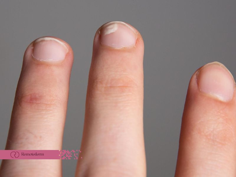 What causes white marks on our nails? Here is what the experts say -  Shëndeti