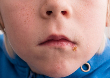 Impetigo can cause blisters