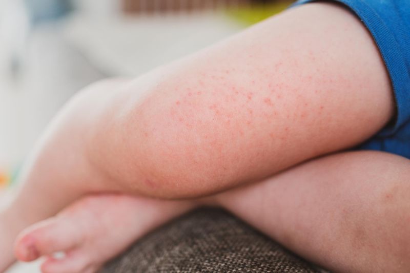 Symptoms of Eczema in Children