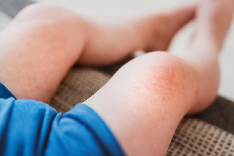 what child eczema looks like