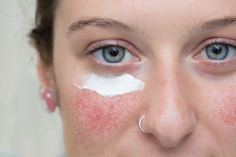 Hydrate to battle winter rosacea