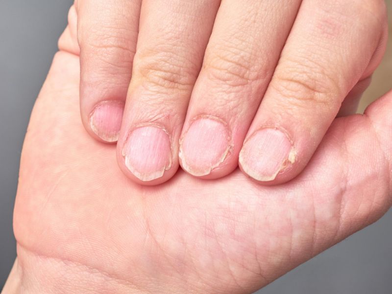 Onycholysis (Nail Separation): Symptoms, Causes & Treatment