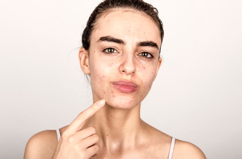 acne vs rosacea Acne symptoms