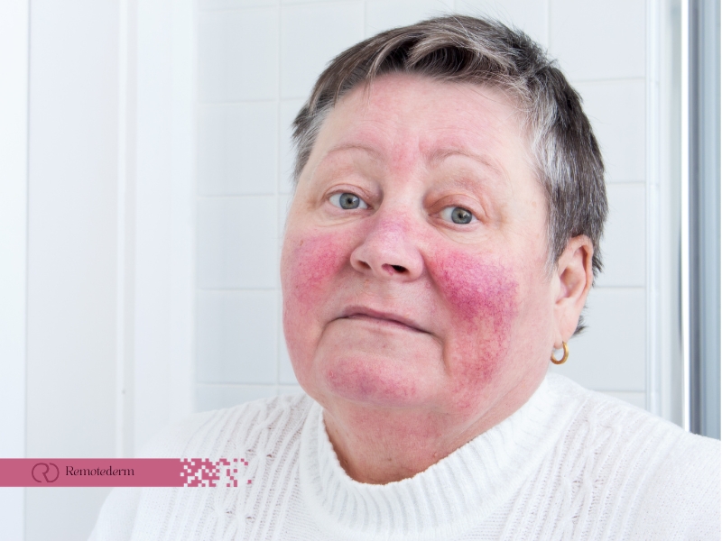Papulopustular rosacea: Causes, symptoms, and prevention
