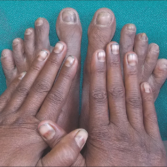 Leukonychia: What Can White Nails Tell Us? | American Journal of Clinical  Dermatology