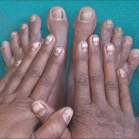 Is the Black Line on Your Nail Normal or Melanoma? How To tell