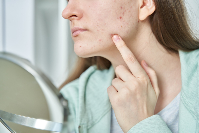 Acne hormonal imbalance symptom
