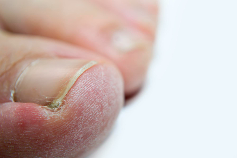 Toenail fungus a common condition