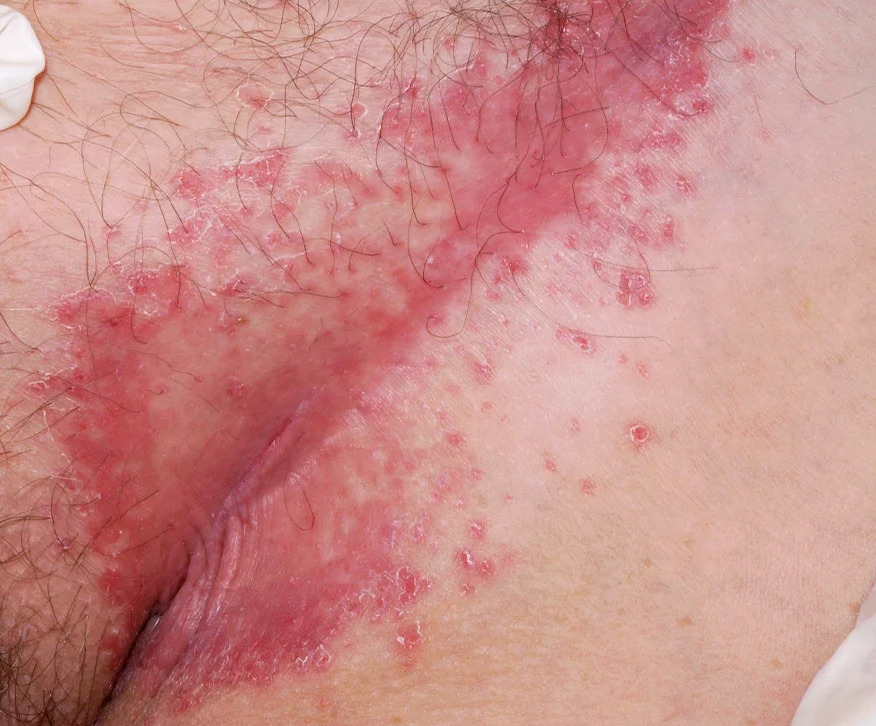 genital psoriasis symptoms