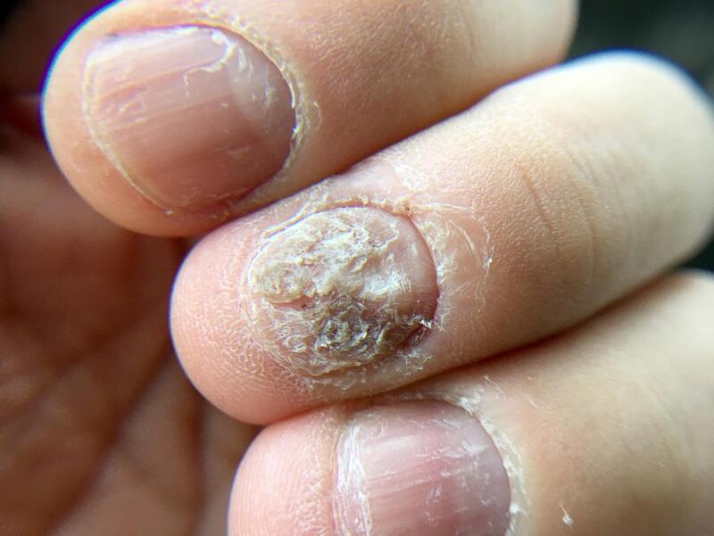 Nail fungus